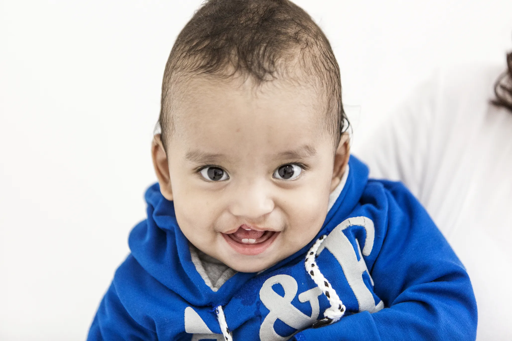 Ethan, 11 months old, smiles before surgery during a 2018 surgical mission in Guatemala City.