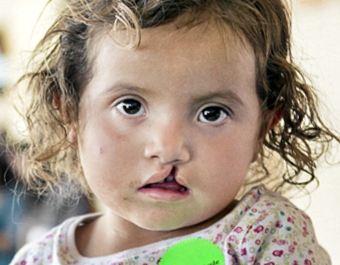 Meet 3-year-old Yitci who received surgery in Tegucigalpa, Honduras.