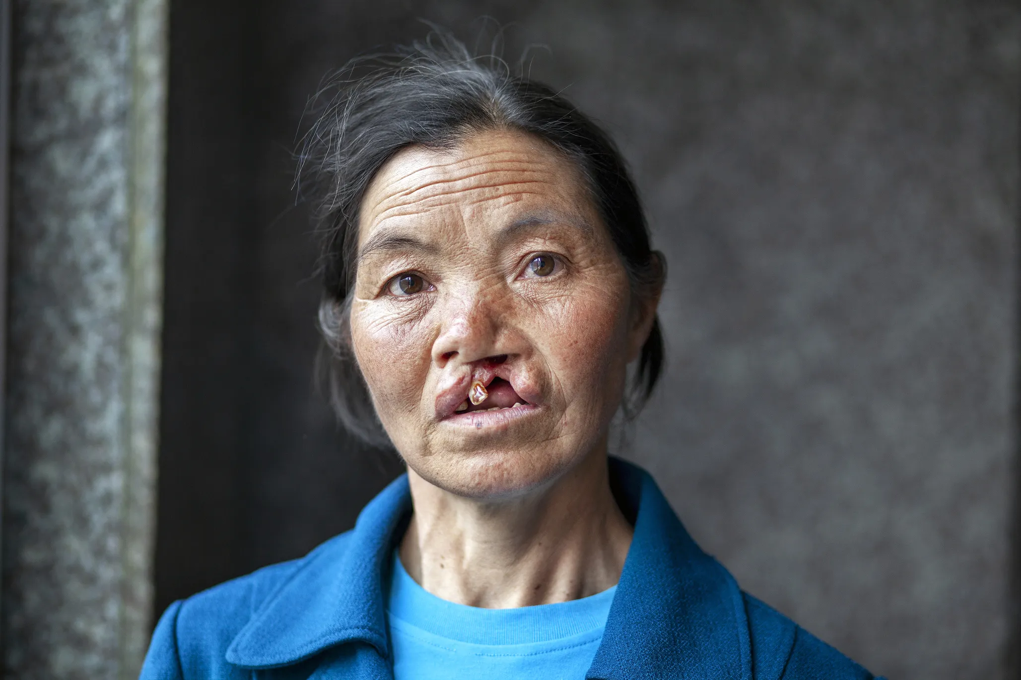 Rong Zhen, 57, before surgery.