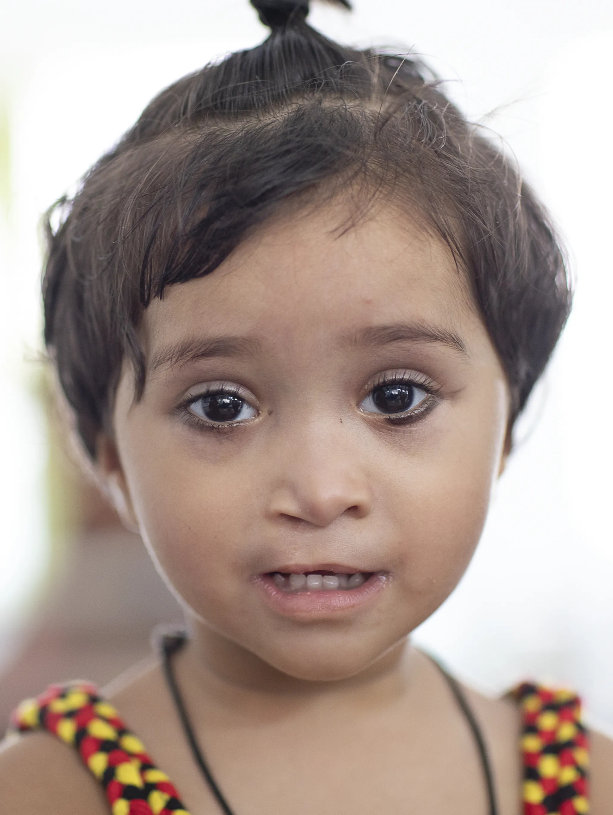 One year after her life-changing cleft lip surgery, 18-month-old Dilfa shares her beautiful smile after receiving care from Operation Smile India.