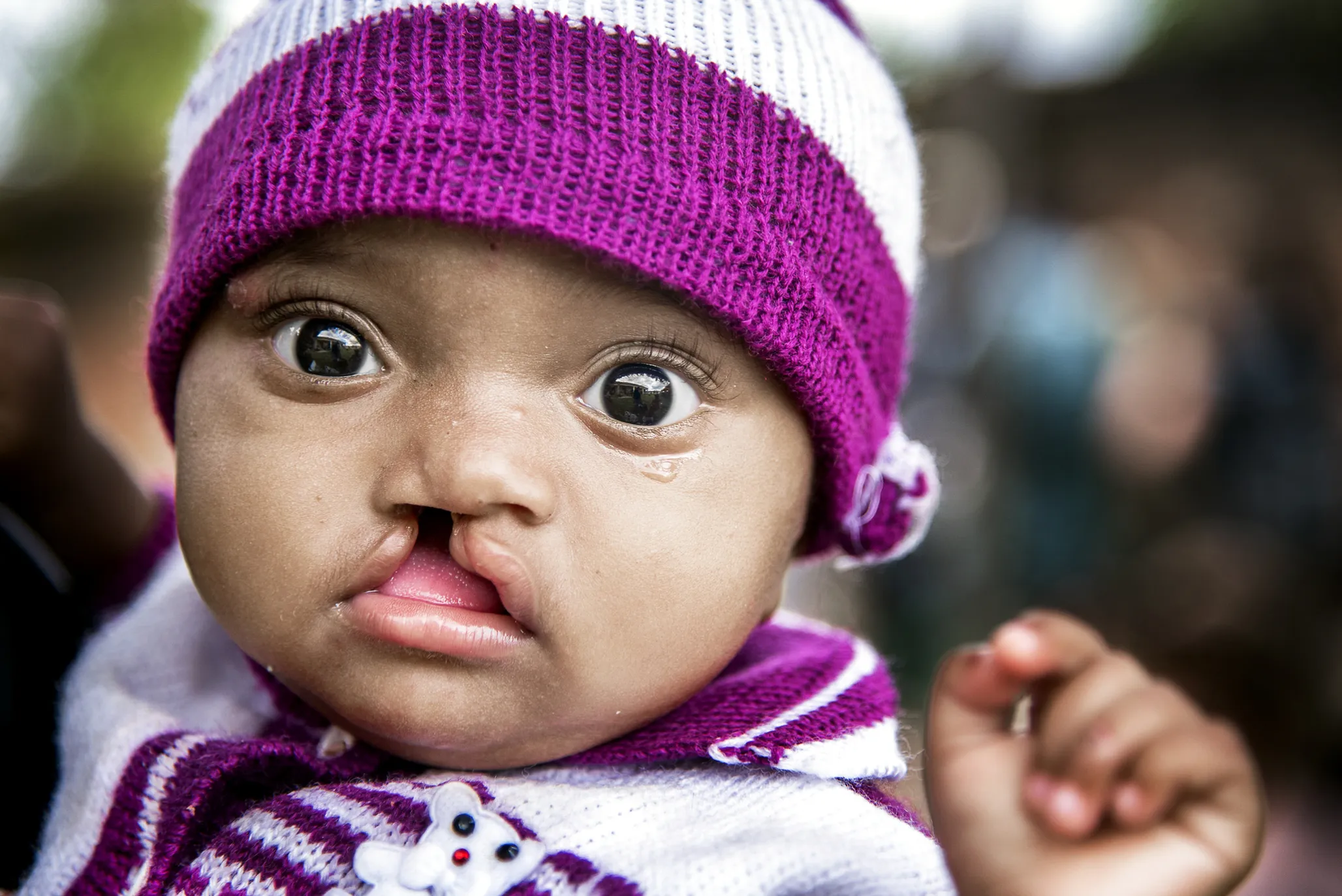 Nine-month-old Larissa was one of the more than 200 patients who received a comprehensive health evaluation at the Antsirabe program site.