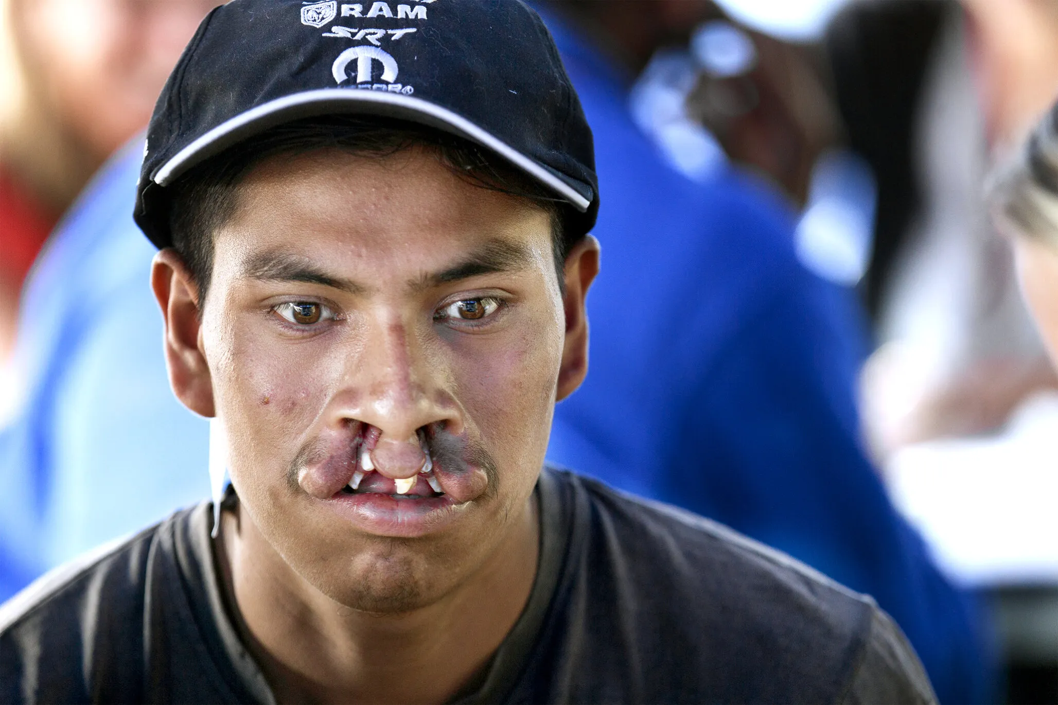 Virgilio, before surgery.